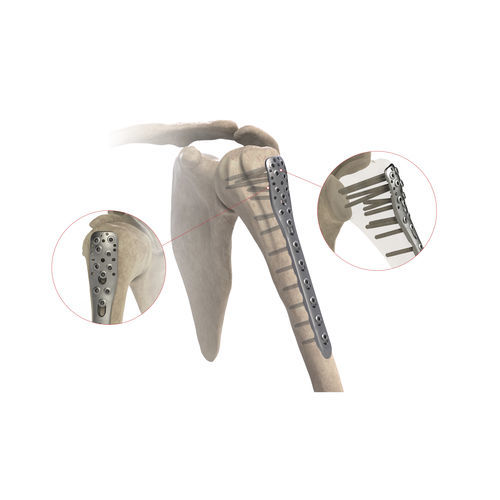 Placa de compresión para húmero - AS.SH.026 - Ases Orthopedics - porción proximal / lateral / bloqueada