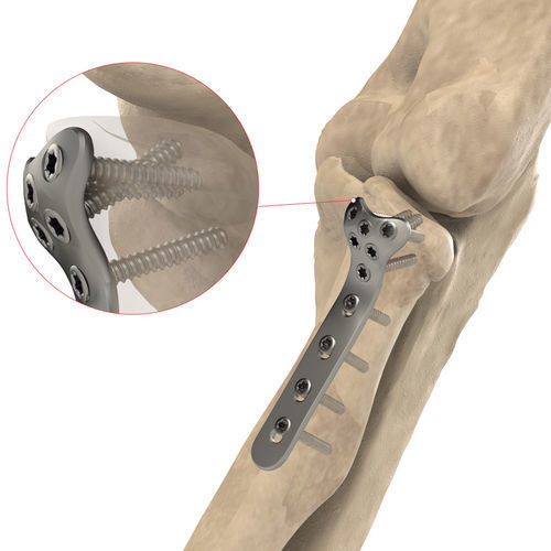 Placa de compresión para cóndilo humeral - AS.E.019 - Ases Orthopedics - porción proximal / bloqueada / de titanio