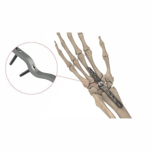 Placa de artrodesis para muñeca - AS.W.074 - Ases Orthopedics - dorsal / bloqueada / no bloqueada