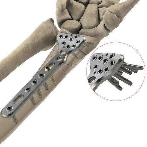 Placa de compresión para radio - DR Volar II - Ases Orthopedics - porción distal / palmar / bloqueada