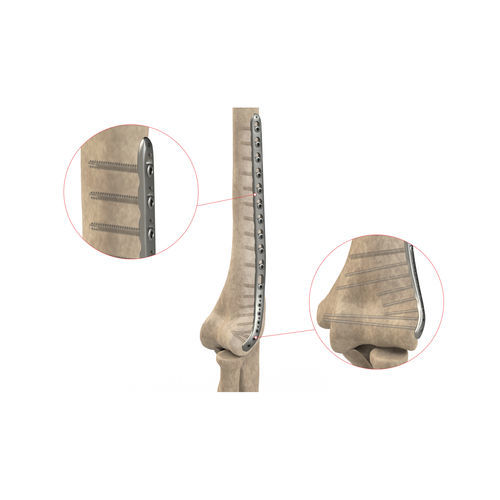 Placa de compresión para húmero - Ases Orthopedics - porción distal / lateral / bloqueada
