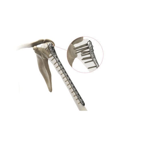 Placa de compresión para húmero - Ases Orthopedics - porción proximal / bloqueada
