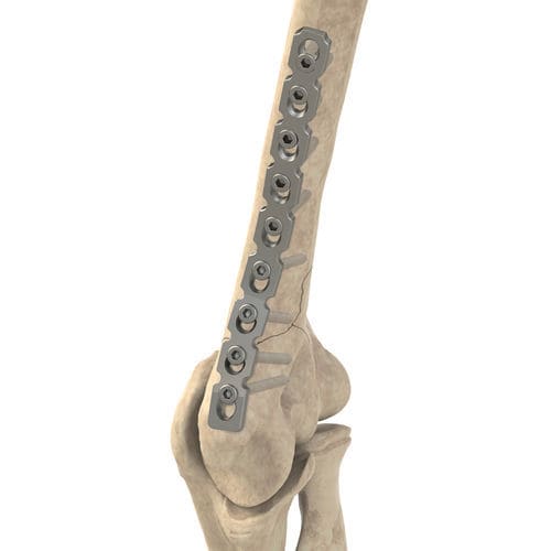 Placa de compresión pelvis - Ases Orthopedics - bloqueada