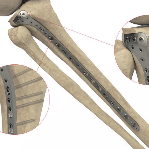 Placa de compresión para tibia - Ases Orthopedics - porción proximal / lateral / bloqueada