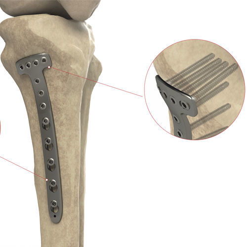 Placa de compresión para tibia - Ases Orthopedics - porción proximal / porción medial / bloqueada