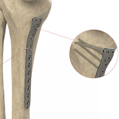 Placa de compresión para tibia - Ases Orthopedics - porción proximal / porción medial