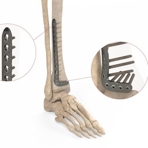 Placa de compresión para tibia - Ases Orthopedics - porción distal / anterolateral / bloqueada