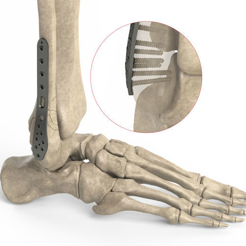 Placa de compresión para peroné - Ases Orthopedics - porción distal / lateral / bloqueada