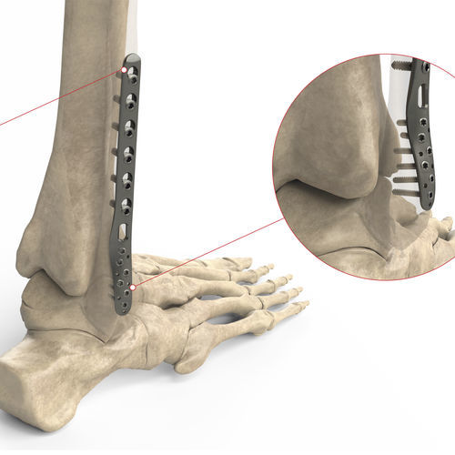 Placa de compresión para peroné - Ases Orthopedics - porción distal / lateral / bloqueada