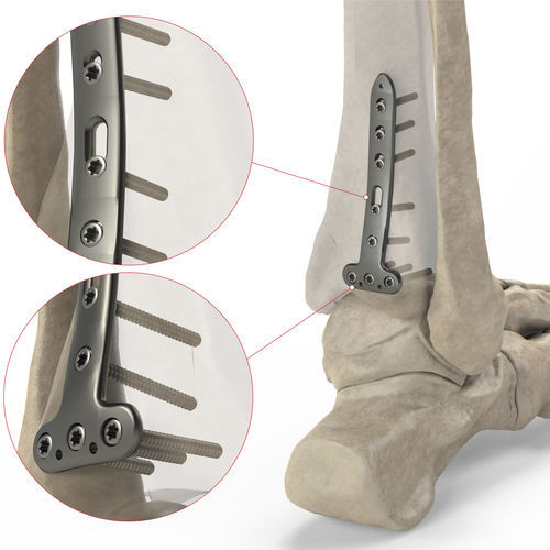 Placa de compresión para tibia - Ases Orthopedics - porción distal / bloqueada