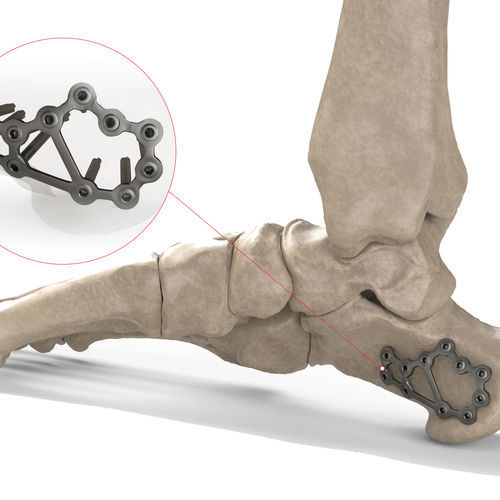 Placa de compresión para calcáneo - Ases Orthopedics - bloqueada