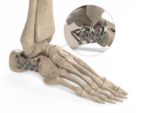 Placa de compresión para calcáneo - Ases Orthopedics