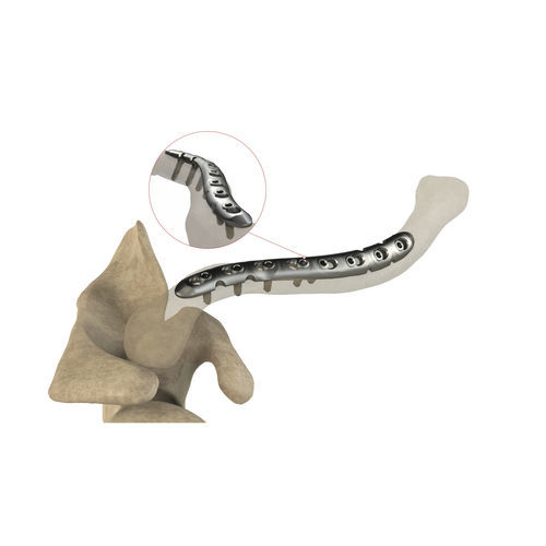 Placa de compresión para clavícula - Ases Orthopedics