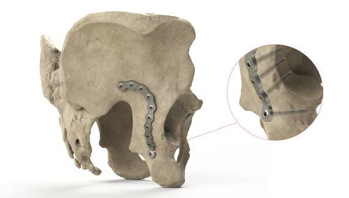 Placa de compresión para pelvis - Ases Orthopedics - posteroproximal