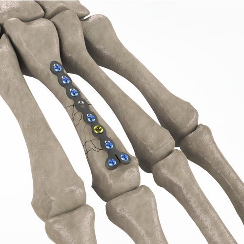Placa de compresión para metacarpo - 1T112-100102023 - Ases Orthopedics - bloqueada