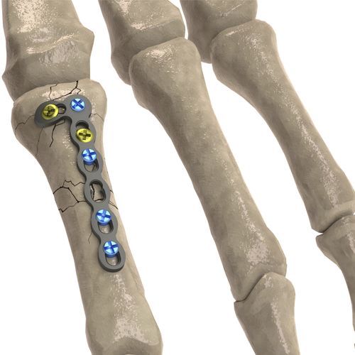 Placa de compresión para falange de la mano - 1T112-100242705L - Ases Orthopedics - bloqueada