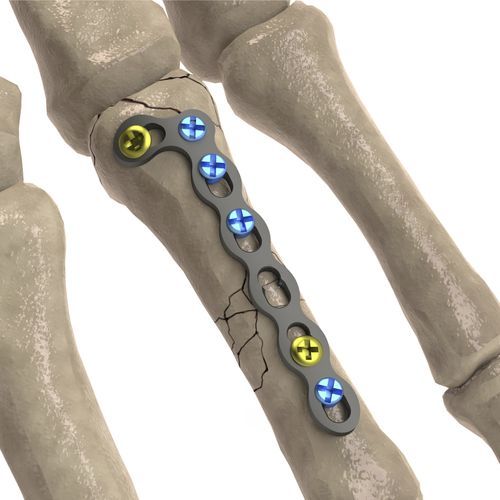 Placa de compresión para falange de la mano - LCP Oblique L - Ases Orthopedics - bloqueada