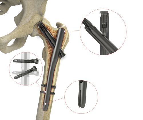 Clavo intramedular para fémur - 4T1-40310170 - Ases Orthopedics - fijación proximal
