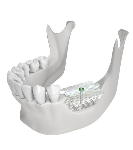 Material dental de titanio - CTi-mem - Neobiotech - para restauración dental