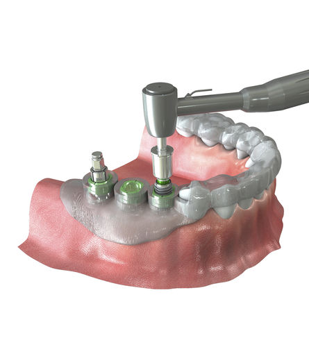 Sistema de navegación quirúrgica para cirugía dental - Neo NaviGuide - Neobiotech - óptico