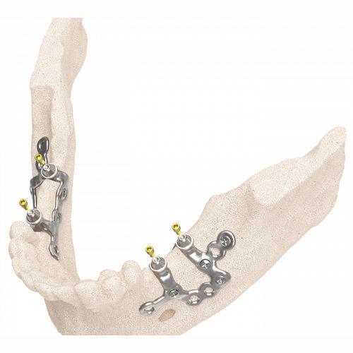 Guía quirúrgica para odontología - IUXTA 3D - Biotec - BTK