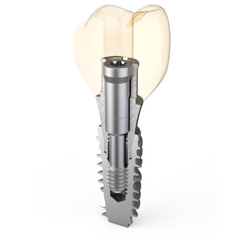 Pilar para implante de titanio - Master Fix - ARUM DENTISTRY Co., Ltd. - externo / en ángulo / de tornillo
