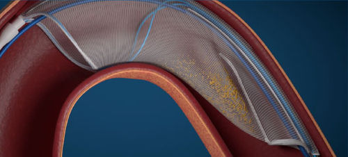 Sistema de protección embólica aórtico - FLOWer - Aorticlab