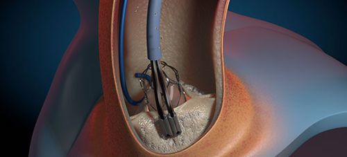 Catéter de aterectomía - GEMINI  - Aorticlab - aórtico