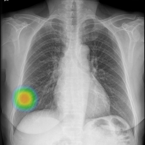 Software de radiografía - INSIGHT CXR - Lunit - médico / de detección / de pulmón