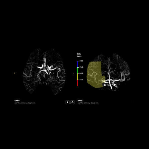 Software médico - CTA - RapidAI - TDM / de angiografía / de tratamiento
