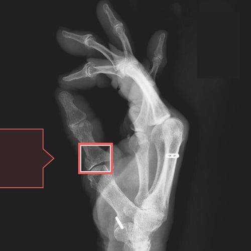 Software de detección de fracturas - RBfracture™ - Radiobotics - médico / de emergencia / de radiología
