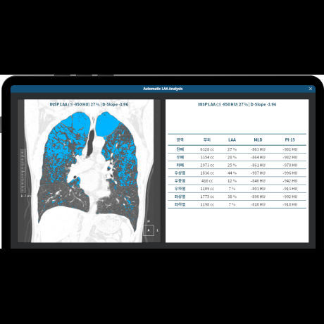 Software médico - LCS PLUS - Coreline - TDM / de análisis / para detección del cáncer de pulmón