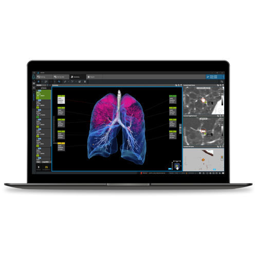 Software para detección del cáncer de pulmón - LCS  - Coreline - médico / TDM / de análisis de imágenes