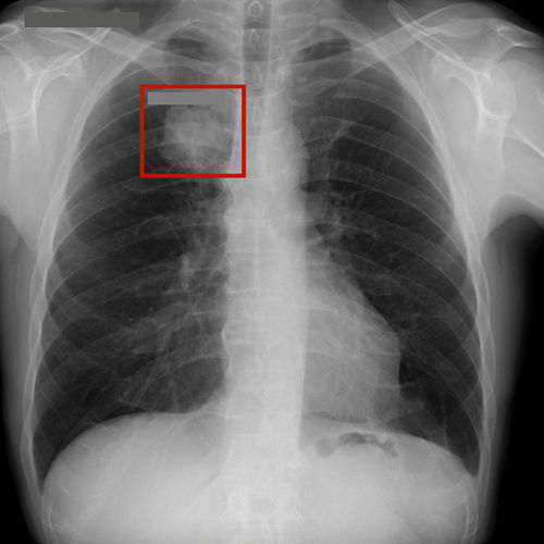 Software de análisis de imágenes - RAYVOLVE - AZmed - de radiología / de pecho / con inteligencia artificial