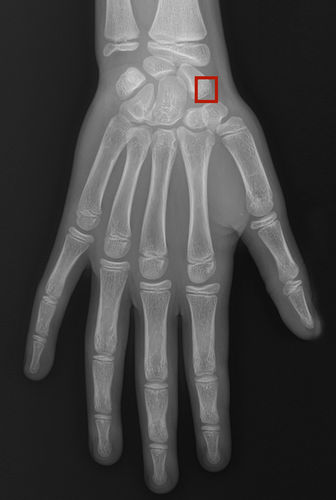 Software médico - Rayvolve - AZmed - de radiología / de análisis de imágenes / de detección de fracturas