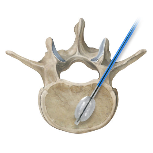 Sistema de aumento vertebral globo - Osteo-Site®  - IZI Medical - aguja / fresa / para vertebroplastia percutánea