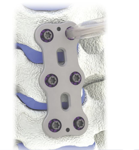 Placa de artrodesis para vértebra cervical - HERO® - HumanTech Dental - 2 niveles