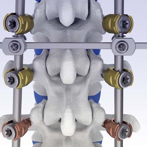 Sistema de osteosíntesis toracolumbar - VENUS® - HumanTech Dental - vía posterior / para adulto