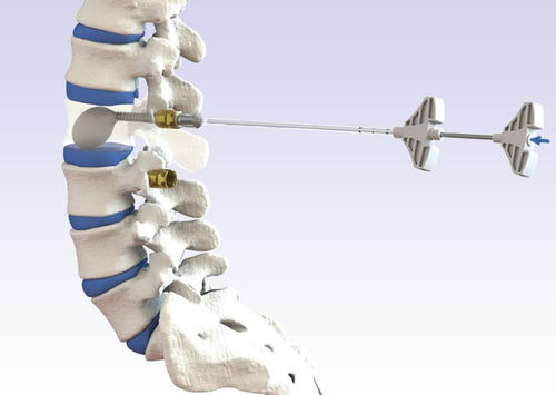 Sistema de aumento vertebral vaina de acceso - VENUS® - HumanTech Dental - para cifoplastia percutánea
