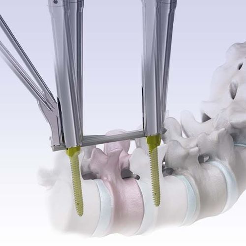 Sistema de posicionamiento de tornillos pediculares mínimamente invasivo - VENUS®mini 2.0 - HumanTech Dental