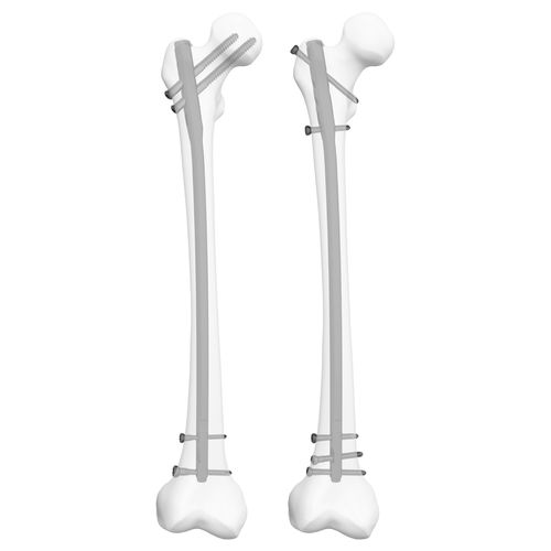 Clavo intramedular para fémur - 305009  - Boneunion Medical - fijación proximal / fijación distal / derecho