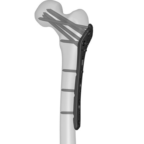 Placa de compresión para fémur - 301040 series - Boneunion Medical - porción proximal / bloqueada / de titanio