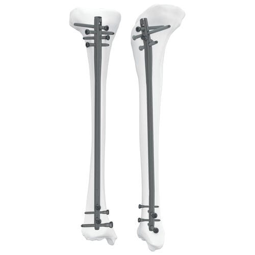 Clavo intramedular para tibia - 305050 series - Boneunion Medical - fijación proximal / fijación distal / derecho