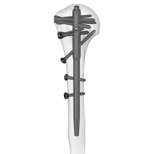 Clavo intramedular para húmero - 305077 series - Boneunion Medical - fijación proximal / fijación distal / derecho