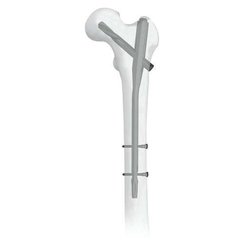Clavo intramedular para fémur - 30500 series - Boneunion Medical - fijación proximal / de titanio