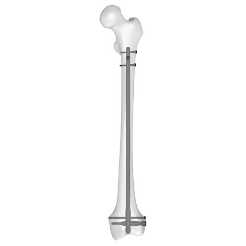 Clavo intramedular para fémur - 30510 series - Boneunion Medical - fijación distal / derecho / izquierdo