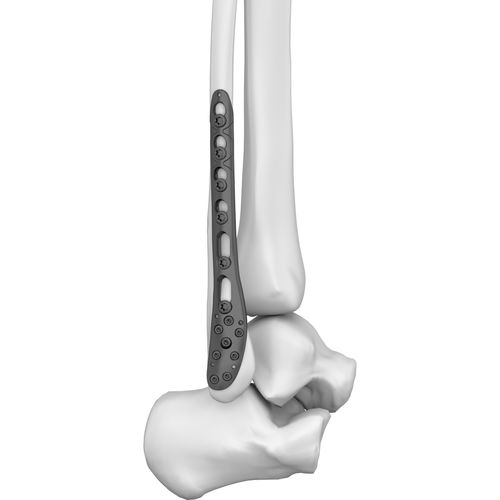 Placa de compresión para peroné - 301019 series - Boneunion Medical - porción distal / bloqueada / de titanio