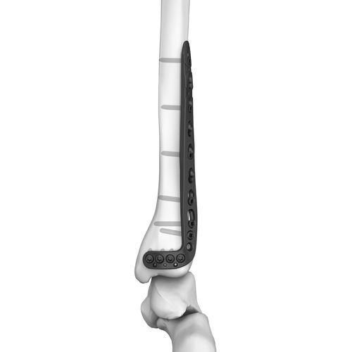 Placa de compresión para tibia - 301026 series - Boneunion Medical - porción distal / lateral / bloqueada
