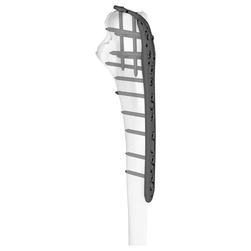 Placa de compresión para olécranon - 301043 series - Boneunion Medical - para cúbito / porción proximal / bloqueada