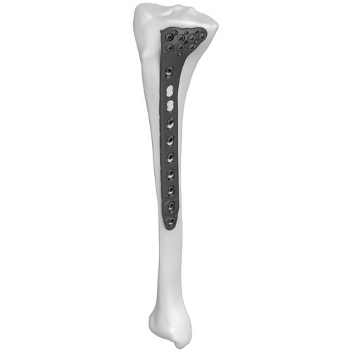 Placa de compresión para tibia - 301022 series - Boneunion Medical - porción proximal / lateral / bloqueada